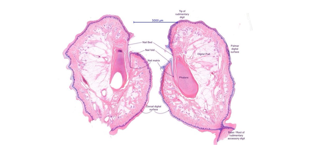 Fascinating! 🤩 3 yr old female, “skin tag” base of ulnar edge of little finger. Structure of an accessory digit! #dermpath #dermtwitter #pathtwitter #dermatologia #dermatology  #dermatologist #histopathology #surgpath #dermatopathologia #dermatopathology #dermatopathologist