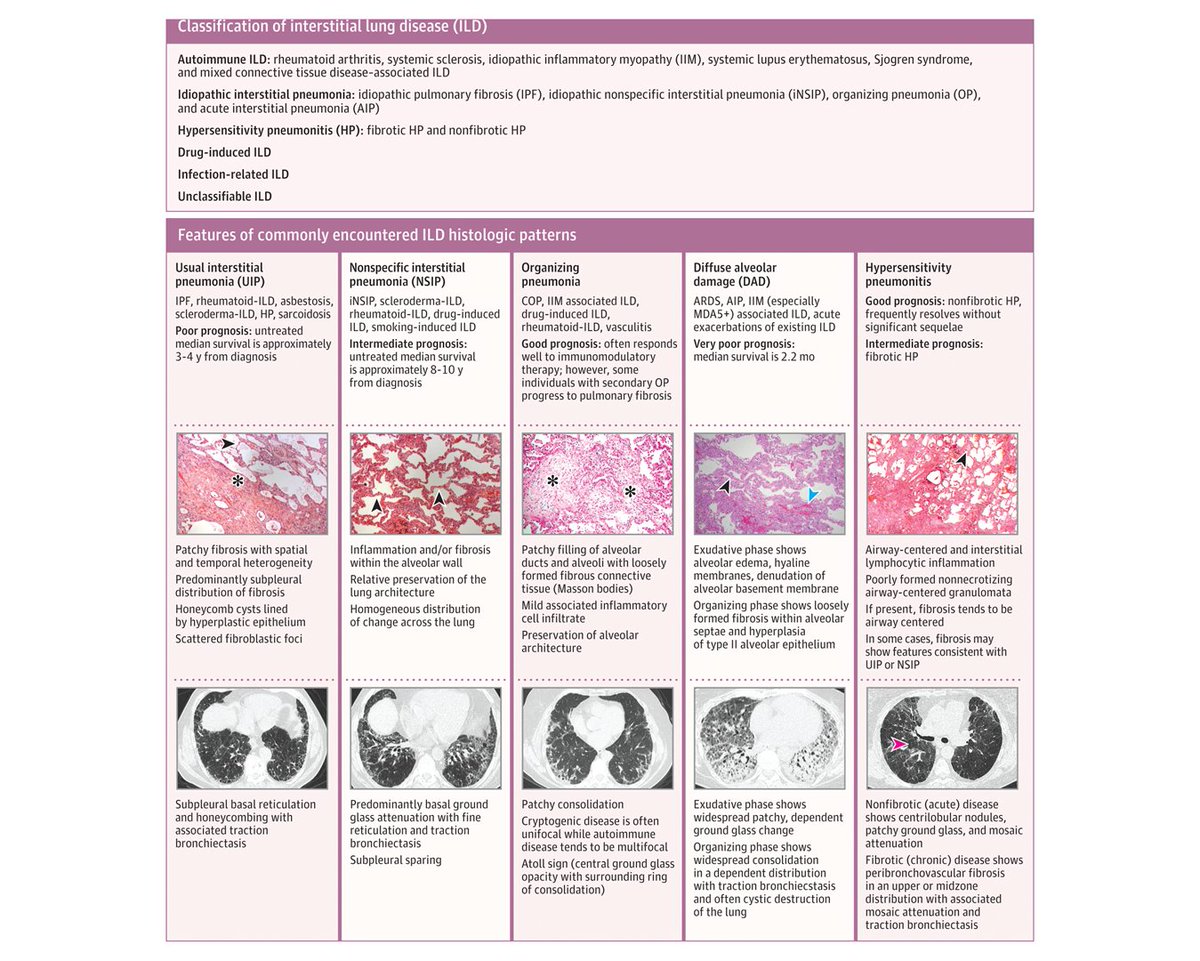 JAMA_current's tweet photo. Review summarizes current evidence regarding the diagnosis and treatment of interstitial lung disease. https://t.co/GNYARlVCQN https://t.co/jUXdWN2S1N