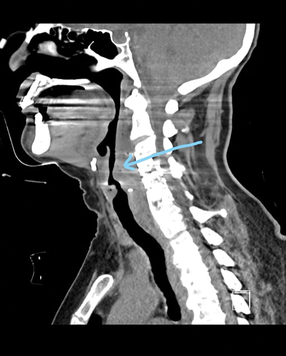 Don't miss the A&A Practice Case of the month Three Episodes of Postanesthesia Paradoxical Vocal Cord Motion Disorder in the Same Patient: A Case Report buff.ly/49OC4Xt