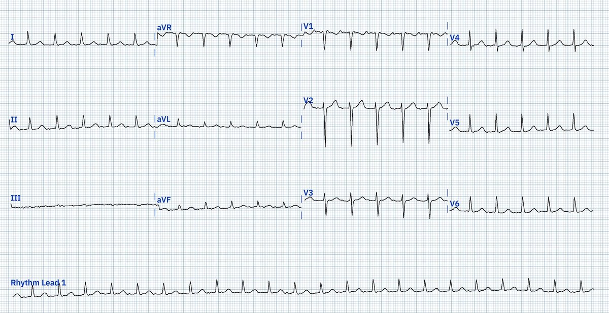 Lead reversals and electrode misplacement can cause alterations in morphology, leading to erroneous interpretation. This is the first time that I have seen it obscure rhythm analysis. LA ↔️ RL hiding atrial activity, but if you look carefully, you can still see 2:1 conduction