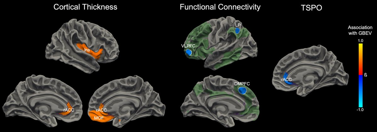 Researchers from @MGHNeuroSci & colleagues identify signs of repeated blast-related brain injury in active-duty U.S. Special Operations Forces: doi.org/10.1073/pnas.2… @USSOCOM @USDOD @USFIAE @USouthFlorida @MGHNeurology @MGHMartinos @MGH_CNTR @MGH_RI @MGHImaging @NavySEALfnd