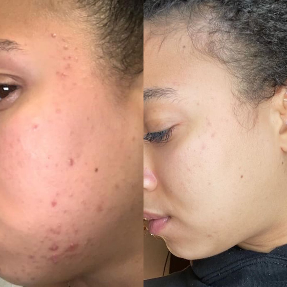 SteliCosmetics's tweet photo. BEFORE &amp; AFTER USING STELI 💚✨ https://t.co/TdArISruD7