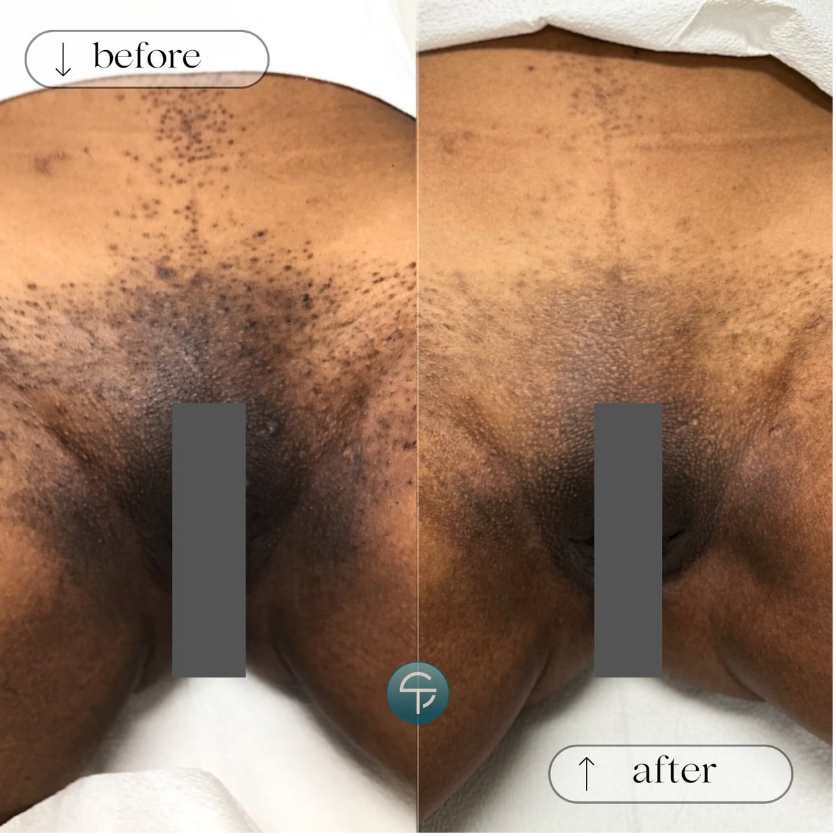 Transforming confidence one session at a time! After only 6 laser hair removal sessions, the difference is undeniable!

#LaserHairRemoval #laserhairremovaltampa #tampa  skintellect.zenoti.com/webstoreNew/se…