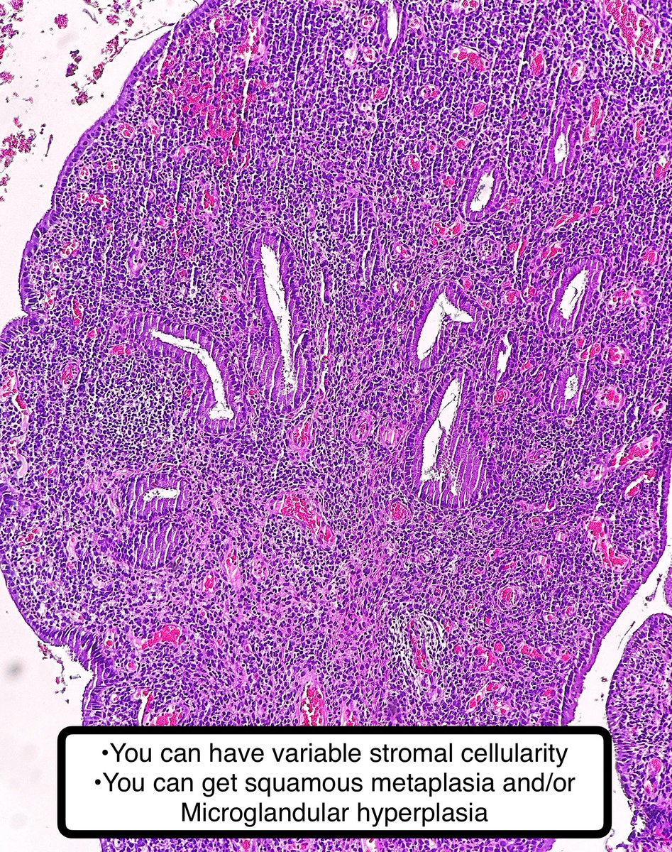 Endocervical Polyp:

• can lead to vaginal bleeding

Sometimes I feel like it (and endometrial polyps) can be hard if sampled just a little bit.

Ddx:
• adenosarcoma (looks like phyllodes tumor)
• adenomyoma
•endometrial polyp

#pathagonia #path4people #pathx #obgyn #fammed