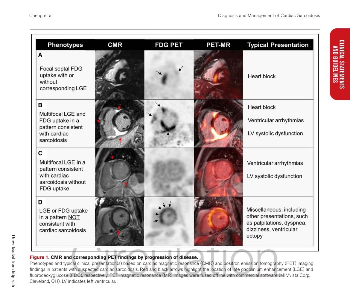 Diagnosis and Management of Cardiac Sarcoidosis: A Scientific Statement From the American Heart Association
dx.doi.org/DOI:10.1161/CI…
#CardioEd #Cardiology #cardiotuiteros #CardioTwitter #MedEd #sarcoidosis