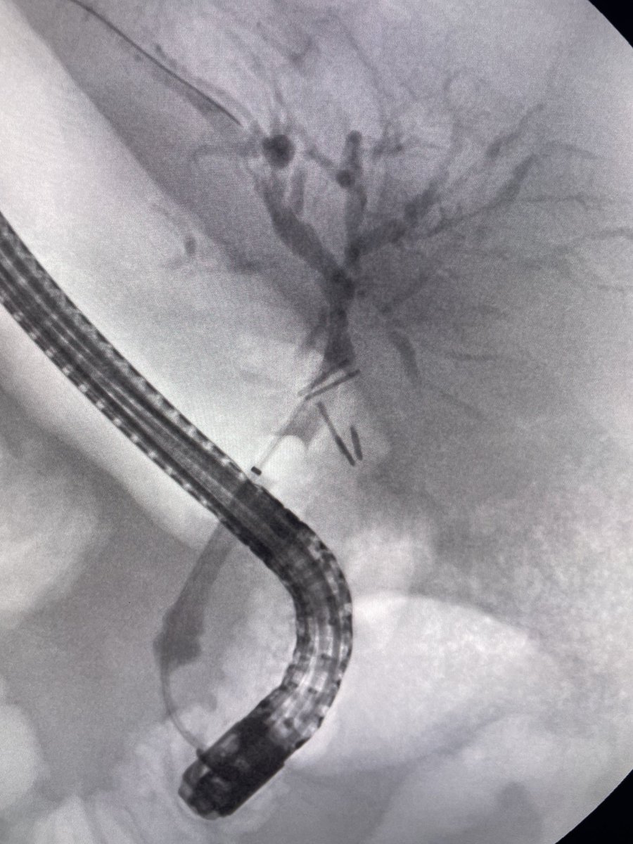 Complex case. PSC in the setting of advanced cirrhosis as well as severe IBD and colorectal cancer. A lot going on. #gitwitter #medtwitter