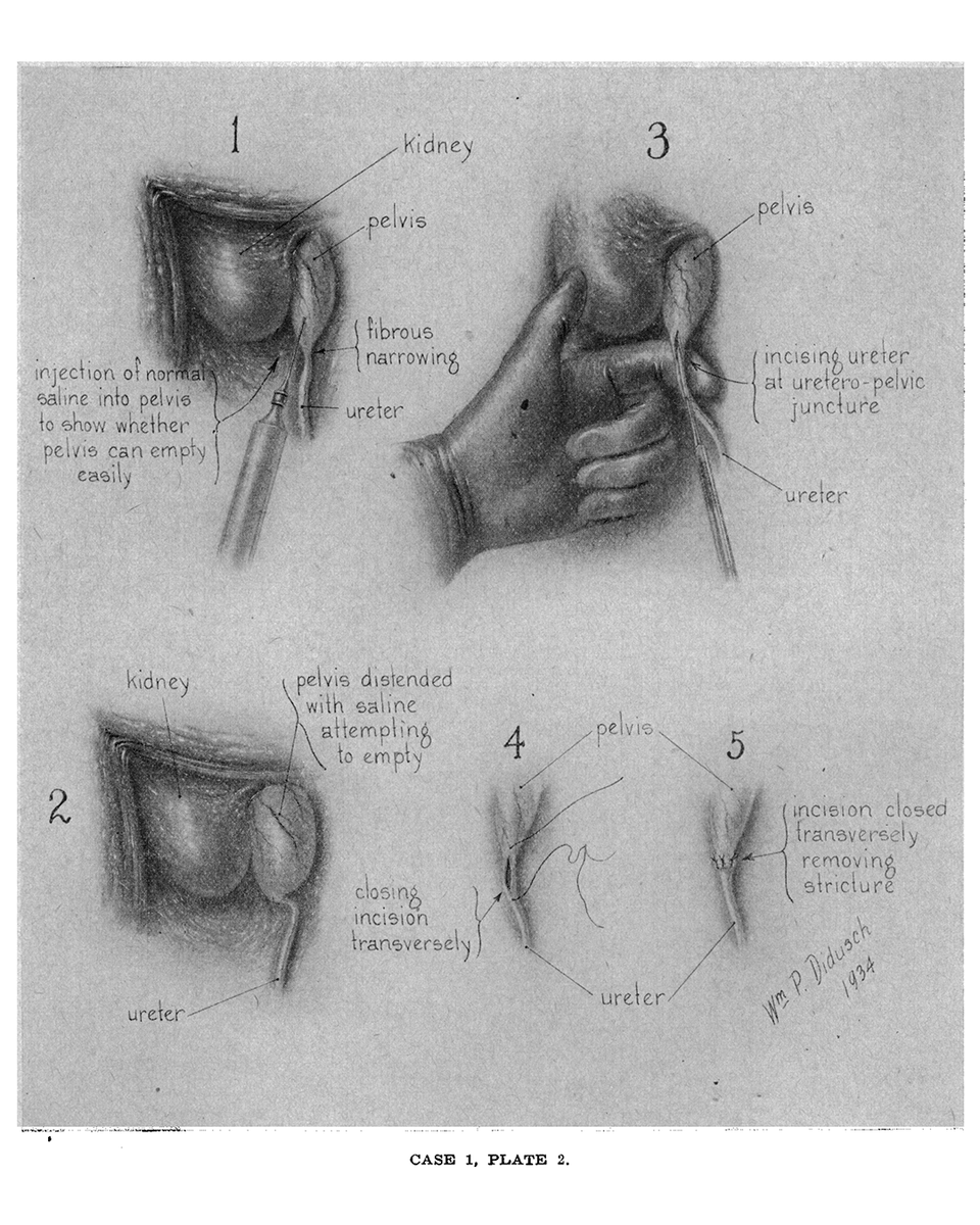 From the NEJM Archive: Non-Calculus Obstructions at the Ureteropelvic Juncture (Original Article, April 18, 1935) nej.md/3Uc5OJb