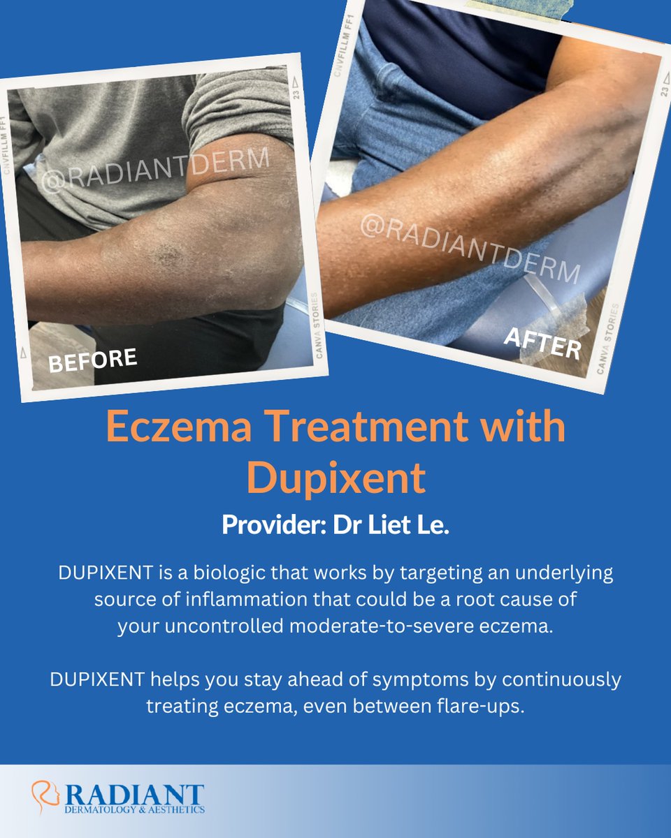 Radiantdermtx's tweet photo. 🎉Thrilled to share the incredible transformation of Dr. Liet Le's patient, who achieved remarkable results in just 4 months with Dupixent treatment! 💫 
Book your appointment today with our provider Dr. Liet Le. 
📞 281-973-4159  
🌐 https://t.co/yZ1KkrugP1 https://t.co/GtcapenQAB