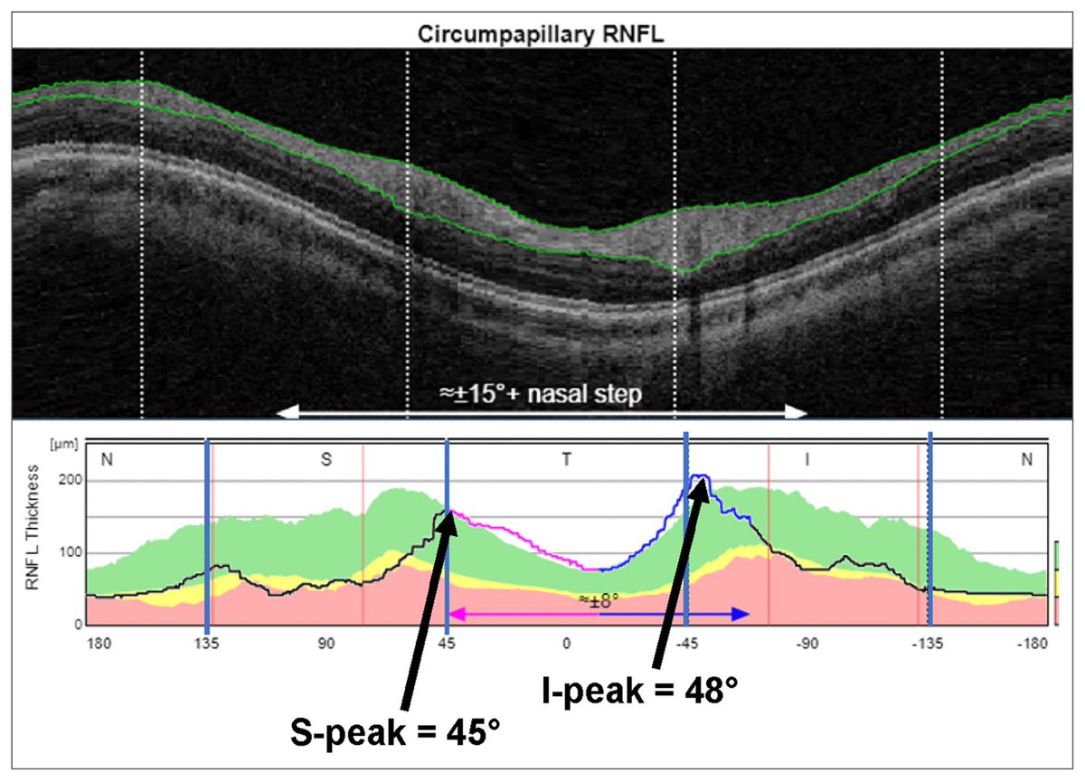 Experts Propose Four New Parameters to Boost Accuracy of Glaucoma Dx on OCT

Fovea-to-disc distance, location of superior and inferior peaks of the cpRNFL thickness curve, and estimated AL all correlated with RNFL thickness more so than age and disc area.
reviewofoptometry.com/article/expert…
