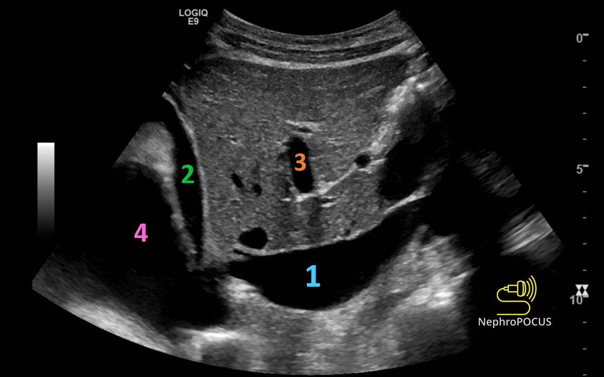 Anechoic exercise!
Identify 1⃣2⃣3⃣4⃣
#POCUS #FOAMed #Nephpearls