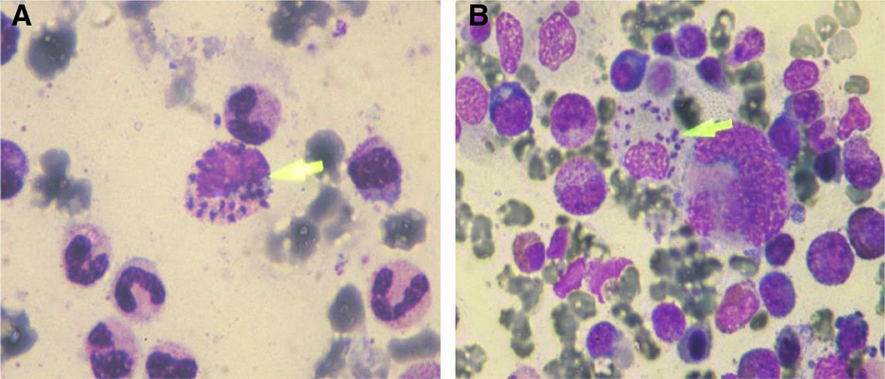 Visceral Leishmaniasis in 2 Patients Treated With Lenalidomide and Dexamethasone: A Possible Correlation With Blunted Immune Response journals.lww.com/hemasphere/ful…