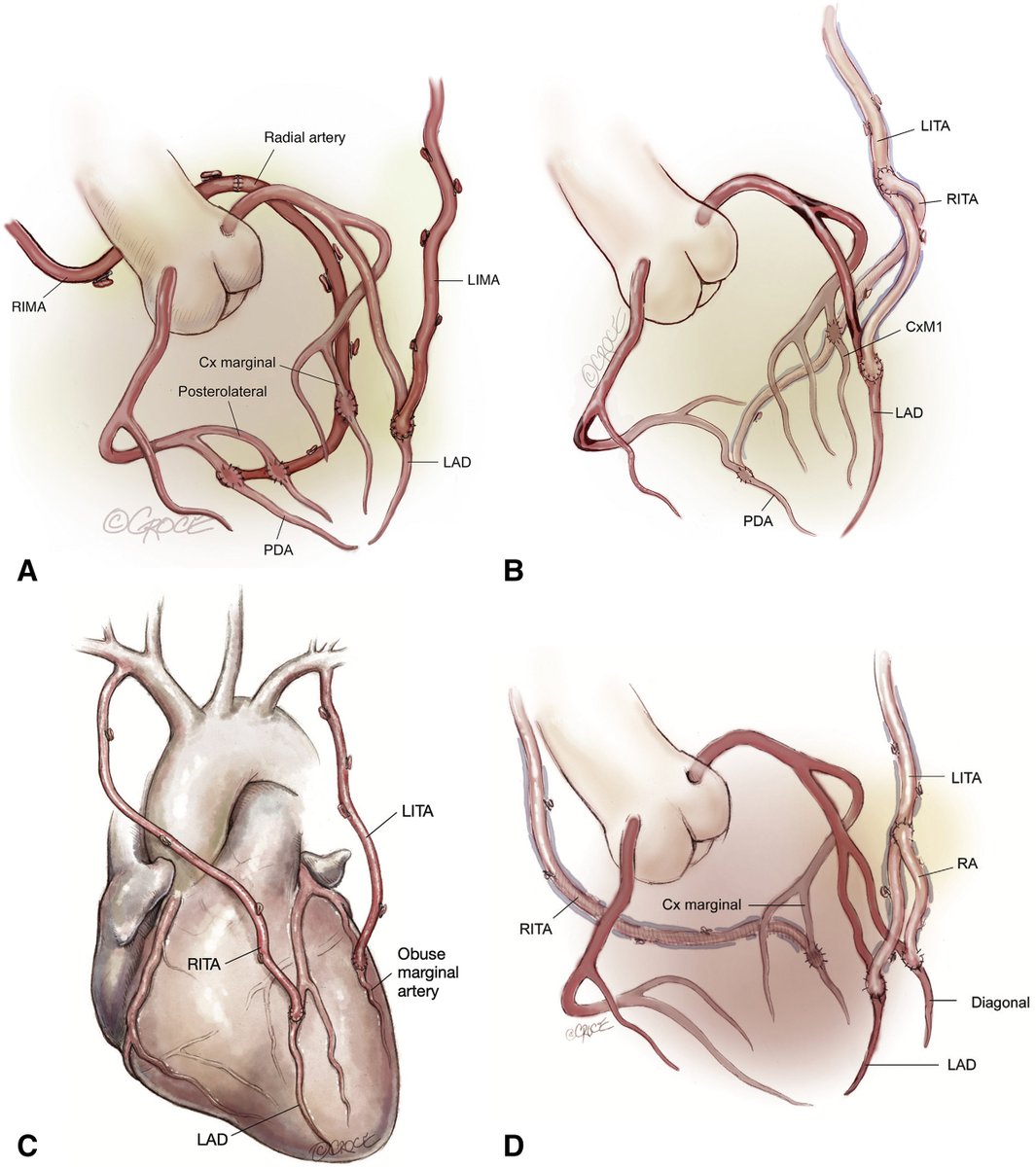#RCM Paper share from Volume 24 / Issue 7 (2023)

📗Conduits and Strategies for Arterial Revascularization in #CABG
✍️Mario Gaudino, et al
🔗imrpress.com/journal/RCM/24…

#coronaryarterybypassgrafting #artery
