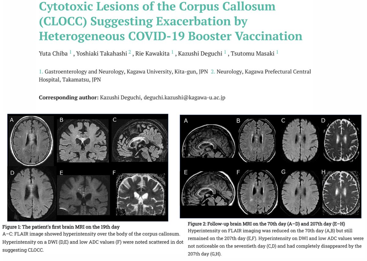 Multiple studies have linked COVID-19 mRNA vaccines (@pfizer, @moderna_tx) with cytotoxic lesions of the corpus callosum (connects the two hemispheres of the brain). Chiba et al showed that these lesions can persist for at least 6 months.
#MFScholar
1. pubmed.ncbi.nlm.nih.gov/37848228/
2.