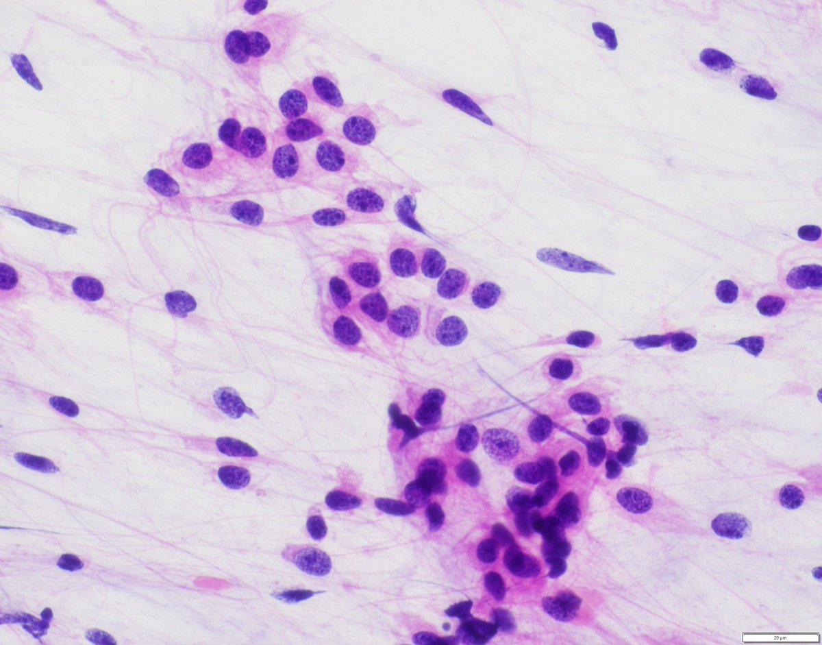 What is the likely diagnosis based on #cytology of this new posterior fossa mass (history of medulloblastoma status post radiotherapy) 🤔

#neuropath #pedipath #pathology #neuroonc