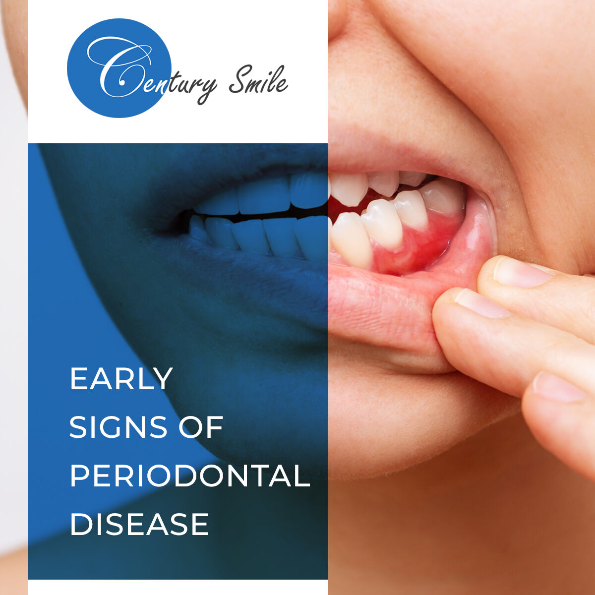 What Is Periodontal Disease? - bit.ly/3a7xXfD

#DentistinCulverCity #CulverCityDentist #DrMaryamTalaie #CenturySmileDental #periodontaldisease #toothextraction #dentalimplants #teethwhitening #rootcanal #AllOn3dentalimplants #Dentist