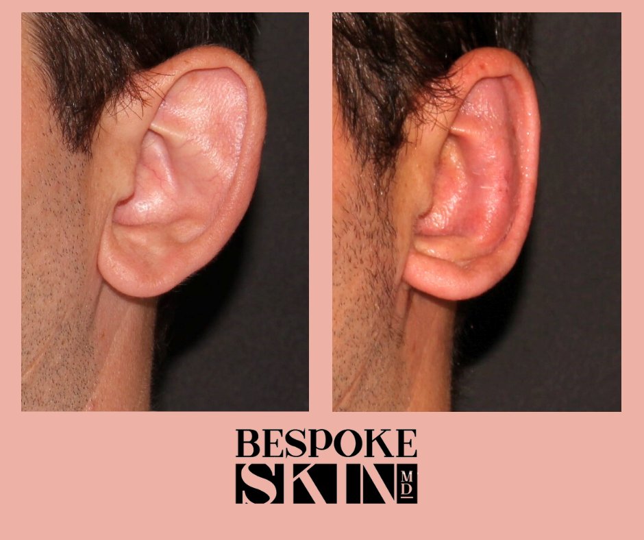 👉Ear pinning can be completed under local anesthesia only
👉Sutures dissolve in 10-14 days, dressing intact for 1 week, sports limited for 6 weeks
#ygk #kingston #kingstonontario #plasticsurgeon #bespokebeauty #earpinning #otoplasty #kingstonbeauty #kingstonaesthetics #otoplasty