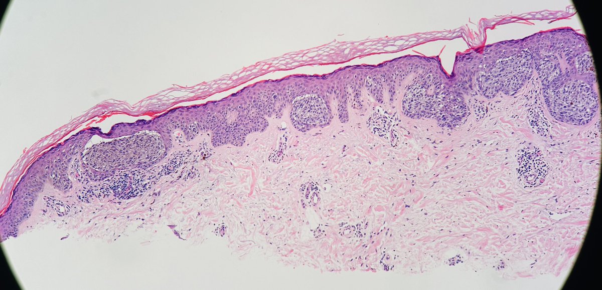 Nested Melanoma. #dermapath 47 yo F. Thigh lesion. It is not Spitz tumor @JacobSmalberger @mccalmo @et565 @MarcelaSaebL @melanopath @tonitatirado @gonzadetoro @ArjunRamaiya1 @redsnapperpath @kis_lorand