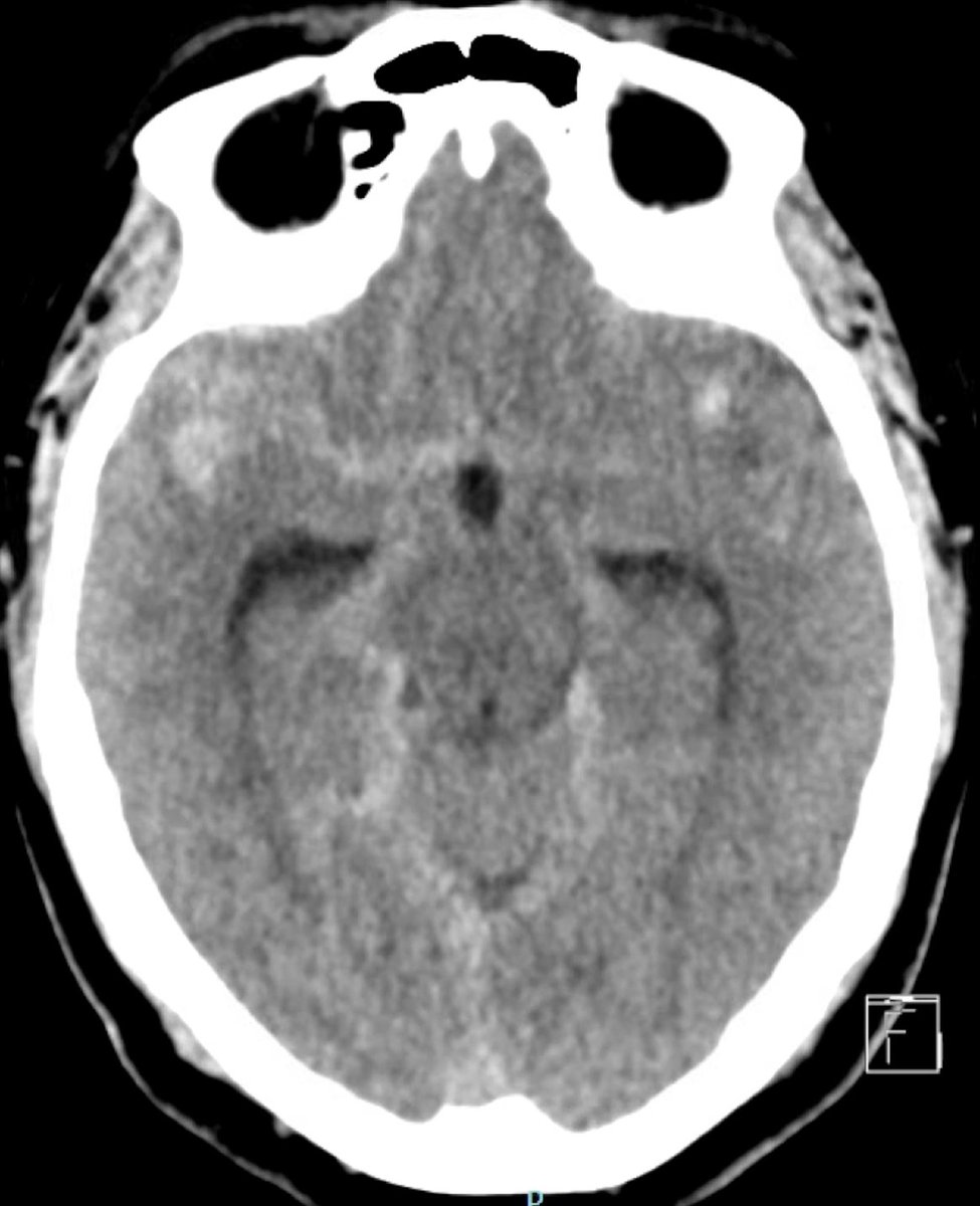 This patient in their 50s arrives to ED. Hunt Hess 2. Microsurgical clipping is planned. What do you do for CSF diversion?