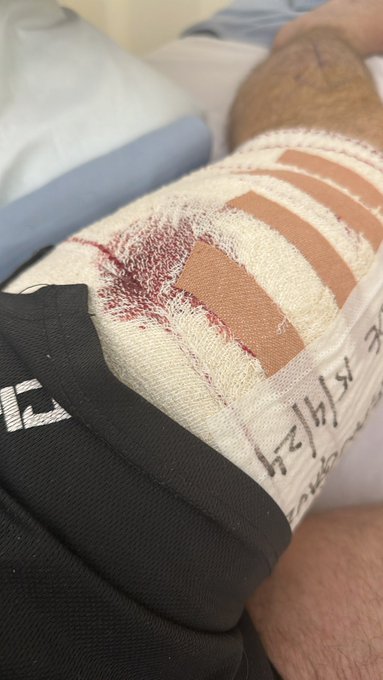 3 weeks of hospital &amp; lucky to be alive. Seizures, compartment syndrome of left leg. 2 emergency surgeries