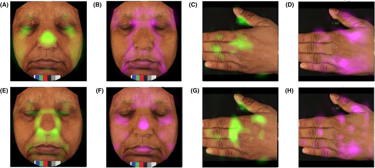 Super cool paper on face and hand aging research using imaging from @hautskintech using data from India (I am not a co-author). Btw. if it works in India - it will work everywhere as the level of skin diversity is highest IMHO. Check it out! onlinelibrary.wiley.com/doi/full/10.11…