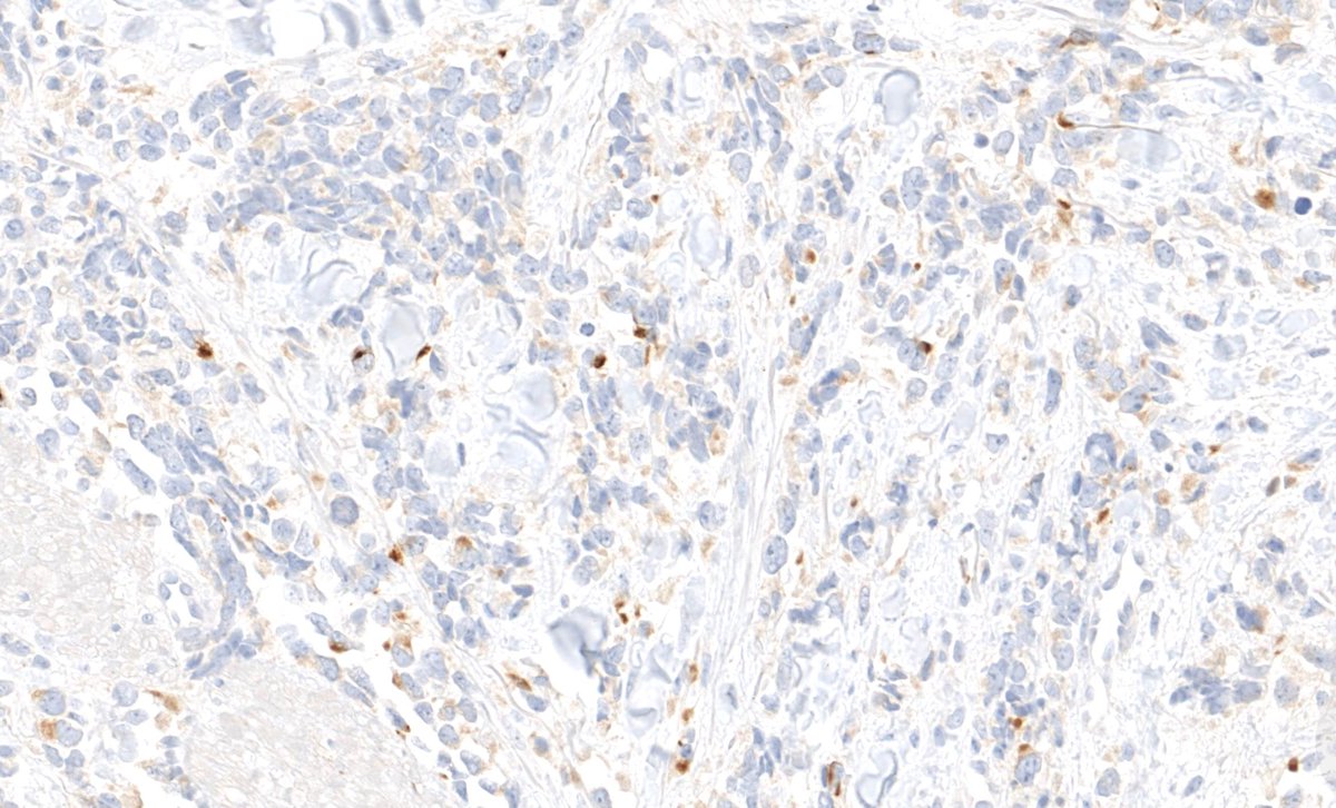 I almost made a BIG misdiagnosis here! 80 F leg skin nodule. Dot-like + panCK & chromogranin. Negative: CK20 synapto TTF-1 CD45. WSI:kikoxp.com/posts/21603 More IHC 🤯 kikoxp.com/posts/21605 Answer:kikoxp.com/posts/21442 #pathology #pathTwitter #dermpath #dermtwitter