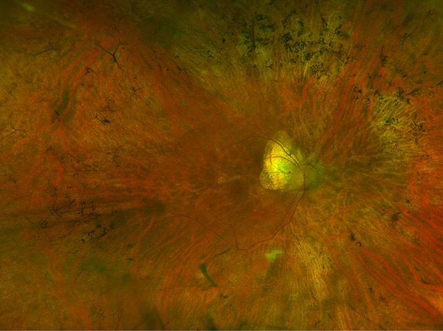 Faulty Photocopies: Rhodopsin #gene duplication newly-identified genetic fault underlying cases of #vision-degenerating disease #retinitispigmentosa and modelling in an #organoid. Image & research by @KandoiSangeetha et al @UofCalifornia in @eLife. On bpod.org.uk/archive/2024/5…