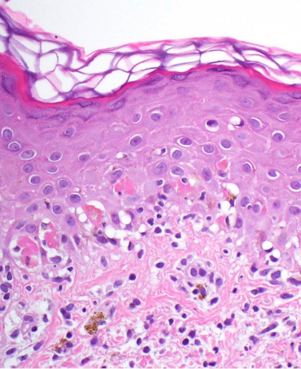 Poor kiddo with a targetoid rash & ulcerated lips/oral mucosa. Your diagnosis? Reply then check your answer here: kikoxp.com/posts/4391 #pathology #pathologists #pathTwitter #dermpath #dermatology #dermatologia #dermtwitter