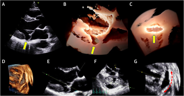 Mitral Annular Disjunction in the Context of Mitral Valve Prolapse: Identifying the At-Risk Patient doi.org/10.1016/j.jcmg… #EchoFirst #CardioEd #cardiotuiteros #CardioTwitter #MedEd #mitralvale