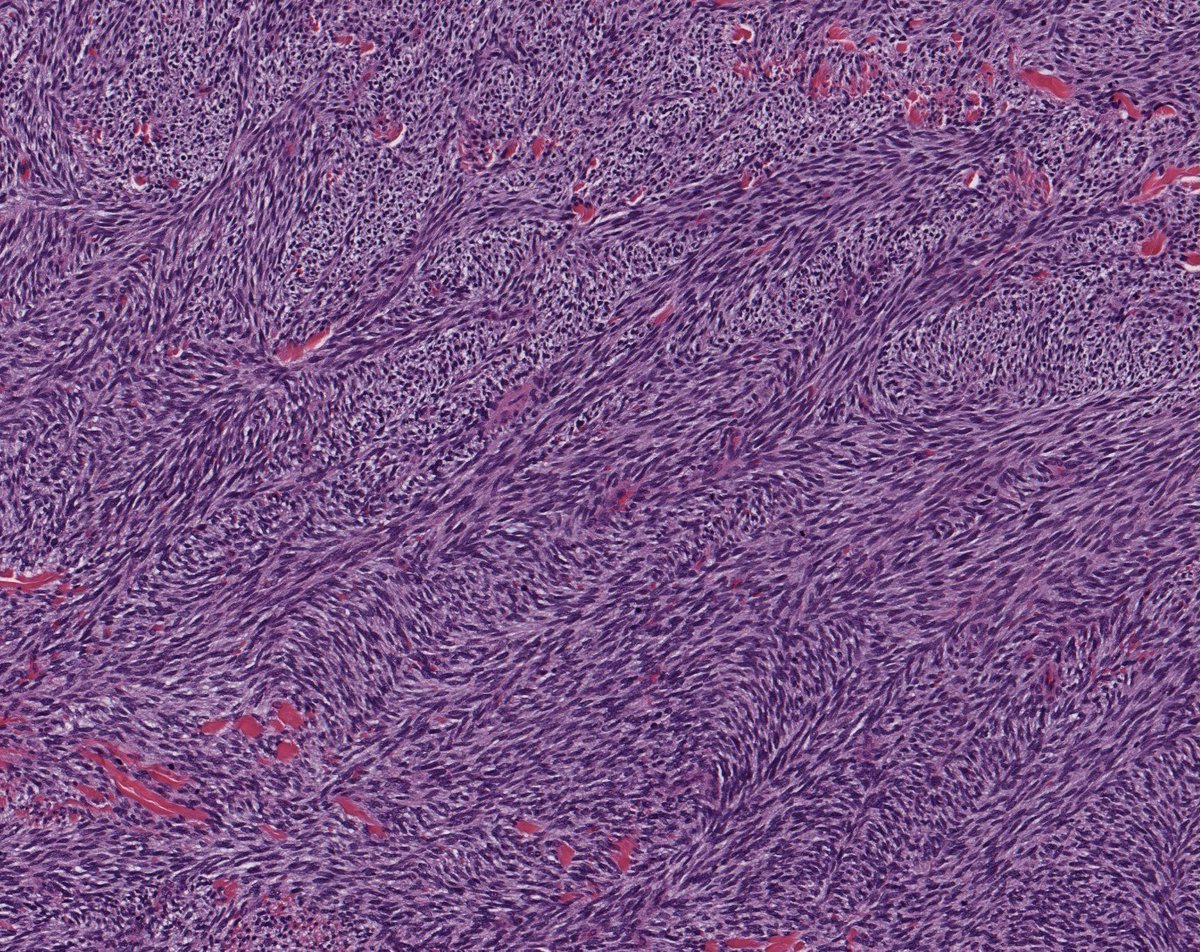 Large soft tissue mass in leg of NF1 patient. Multiple mitoses. S100 negative. Diagnosis: kikoxp.com/posts/4092. Name of the pattern & list of other tumors that can have it explained here: kikoxp.com/posts/14062. #BSTpath #pathologists #pathology #pathTwitter #dermpath