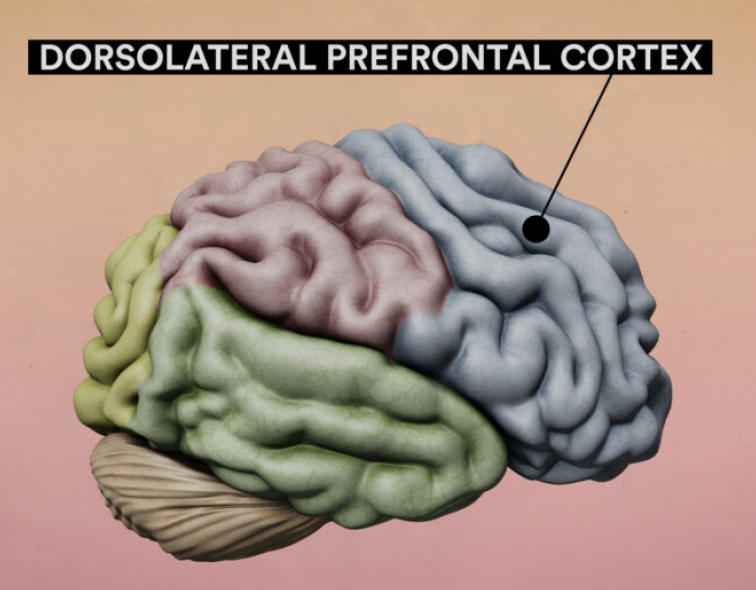 MichaelOkun's tweet photo. Would you donate 1 cubic centimeter of tissue on each side of your brain 'for research' while undergoing deep brain stimulation? Katherine Eban has published a new comprehensive investigative report in @statnews which details the emerging controversy about the "Living Brain Project at Mount Sinai in NY.
Key Points:
Katherine Eban in July 2022, filed suit with the National Institutes of Health, the Food and Drug Administration, and the Department of Health and Human Services to 'obtain records related to Mount Sinai’s Living Brain Project.'
- She offers a comprehensive look at federal oversight, funding, and regulation. 
- There is ongoing litigation.
- She includes interviews with persons affected.
My take: Perhaps we should start with, 'how big' is this tissue donation? The description provided in the story states 'a cubic centimeter is about the size of a small bouillon cube.' For those of you, like me, at a loss for understanding this description, a bouillon cube is a 'dehydrated broth or stock which can be shaped into a small cube.' In brain space that seems large to me. There have been groups who collect cells from recording electrodes, infected leads or broken devices, and that certainly is a safer, albeit lower yield approach to studying the cells contained in the 'living brain.' Ethics research by @GLMbioethics, Giordano, Kubu and other academics should remind us that that when people receive DBS and other neurosurgical procedures they are a potentially vulnerable population.  The person executing the consent process for an 'add on research project' should always address the challenge that the 'urgency for treatment frequently translates into an informed consent process where those seeking surgery are desperate and may agree to anything.'  All four people interviewed by STAT shared 'that at the point they consented, they were so desperate for effective treatment they would have agreed to almost anything.' This story and project should set off the alarm bells for how we can improve our processes to both protect people with diseases and also provide data for research. Personally, I would not consent to allowing a bouillon sized cube to be removed from each side of my brain for research purposes. Of course I have an advantage as I have some advanced knowledge in this arena.  Where do you stand? It's time for dialogue folks.
https://t.co/uV2rpukoHT #Parkinsons #depression #deepbrainstimulation @DBSThinkTank