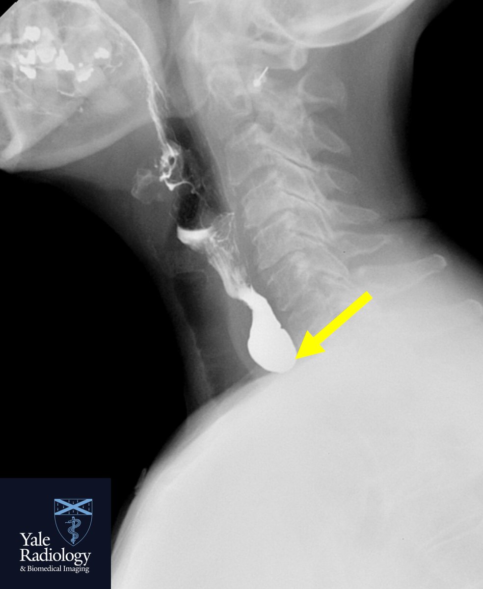 TEACHING COD: Classic example of a Zenker’s diverticulum; some presenting symptoms include dysphagia, halitosis, globus sensation; results from herniation through the Killian dehiscence #yaleradedu #yaleradiology #FOAMrad #FOAMed #radres #medstudent #radiology @Mahan_Mathur…