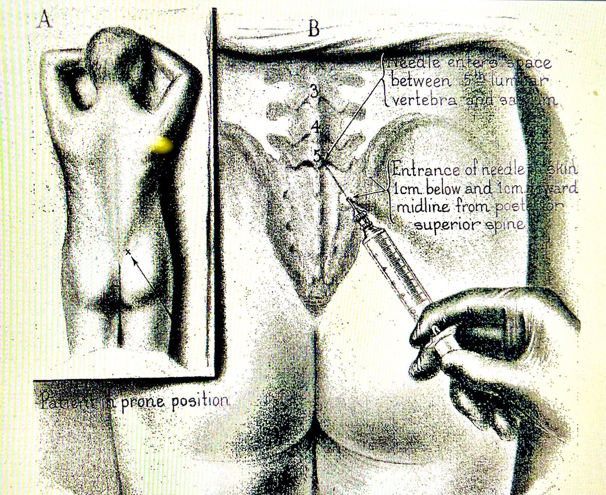 The 'Taylor' spinal enters the IT space between L5 and the sacrum. It can be used when the lumbar approach is fused. This Figure from JA Taylor's 1940 paper (Journal of Urology, 43:561) illustrates the technique. The patient is prone. Taylor was a practicing urologist in NYC.