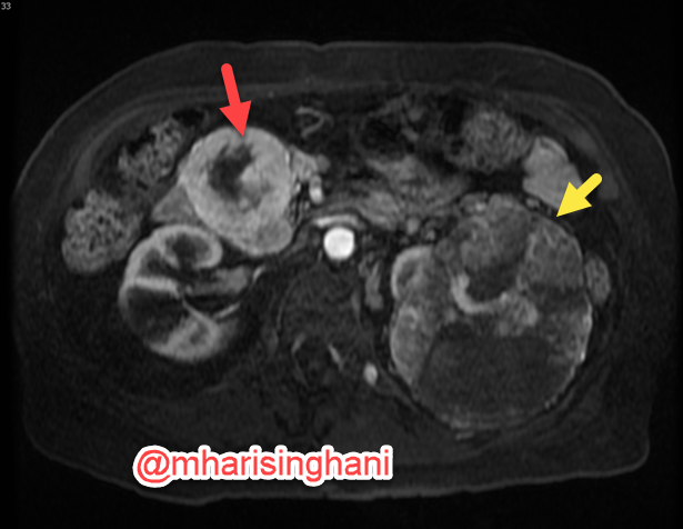 one image says it all: pancreatic metastases from clear cell RCC