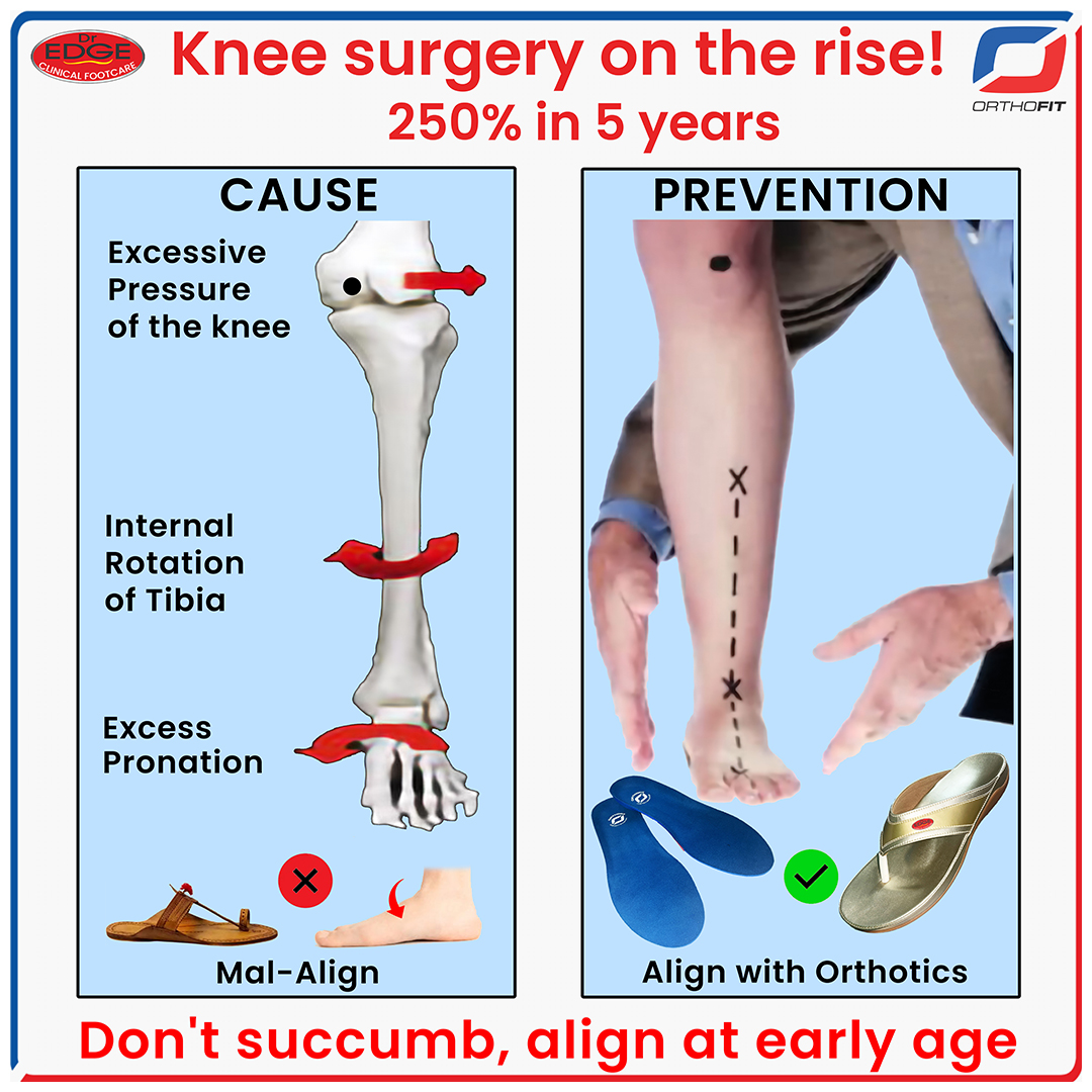 Knee surgery on the rise !
#orthofit #orthofitclinic #kneepain #kneereplacement #gaitanalysis #podiatry #podiatristmumbai #podiatrymumbai #podiatrist #orthofitmart #edge #edgefootwear #orthoticfootwear #correctivefootwear