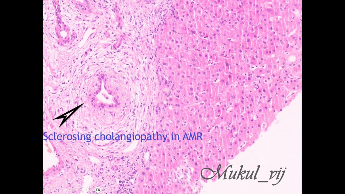 Hi #PathX 
Check out this incredible image of sclerosing cholangiopathy in a case of Acute AMR (ABO compatible graft) with persistent high DSA titers
#livertransplant #liverpath #rejection