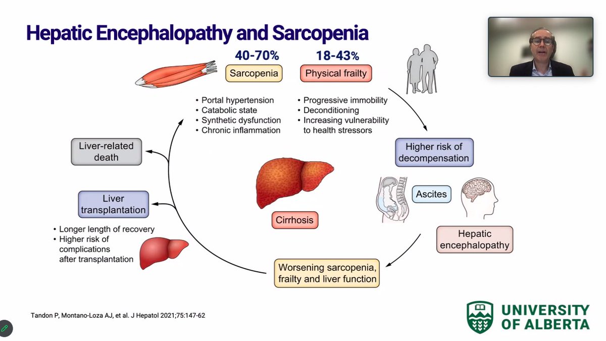 Sarcopenia in patients with cirrhosis is associated with higher risk of decompensation including HE and death 💪🤯 how to evaluate and treat it is being reviewed by @aldomontanoloza in @ISHENtranslatio