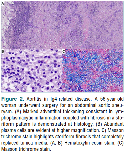 Check out the review 'Cardiovascular pathology in vasculitis', part of the #Pathologica vasculitis and organ pathology issue! #PathX #PathTwitter #PathResidents
