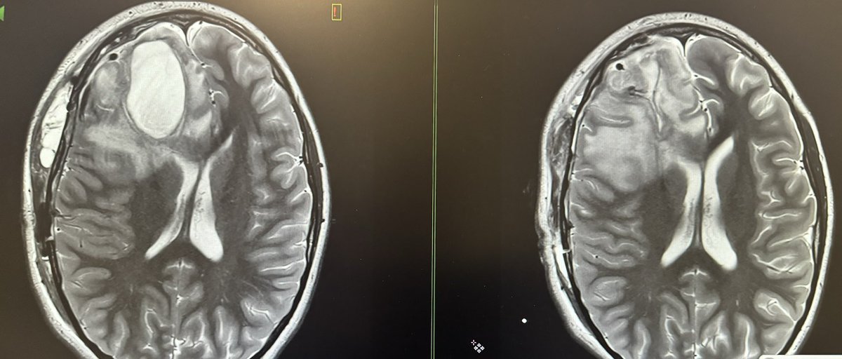 Recurrent brain abscess of unclear etiology in a young girl. Pre (left) and post (right) from washout. Think local spread (sinuses, post-op, dental, trauma) or hematogenous (cardiac, pulmonary, CF, septicemia). Can be small AVFs or AVMs. #neurosurgery #neurotwitter #MedTwitter