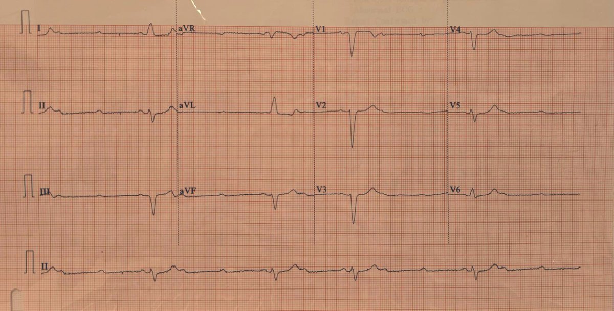 Which type of heart block is seen here?