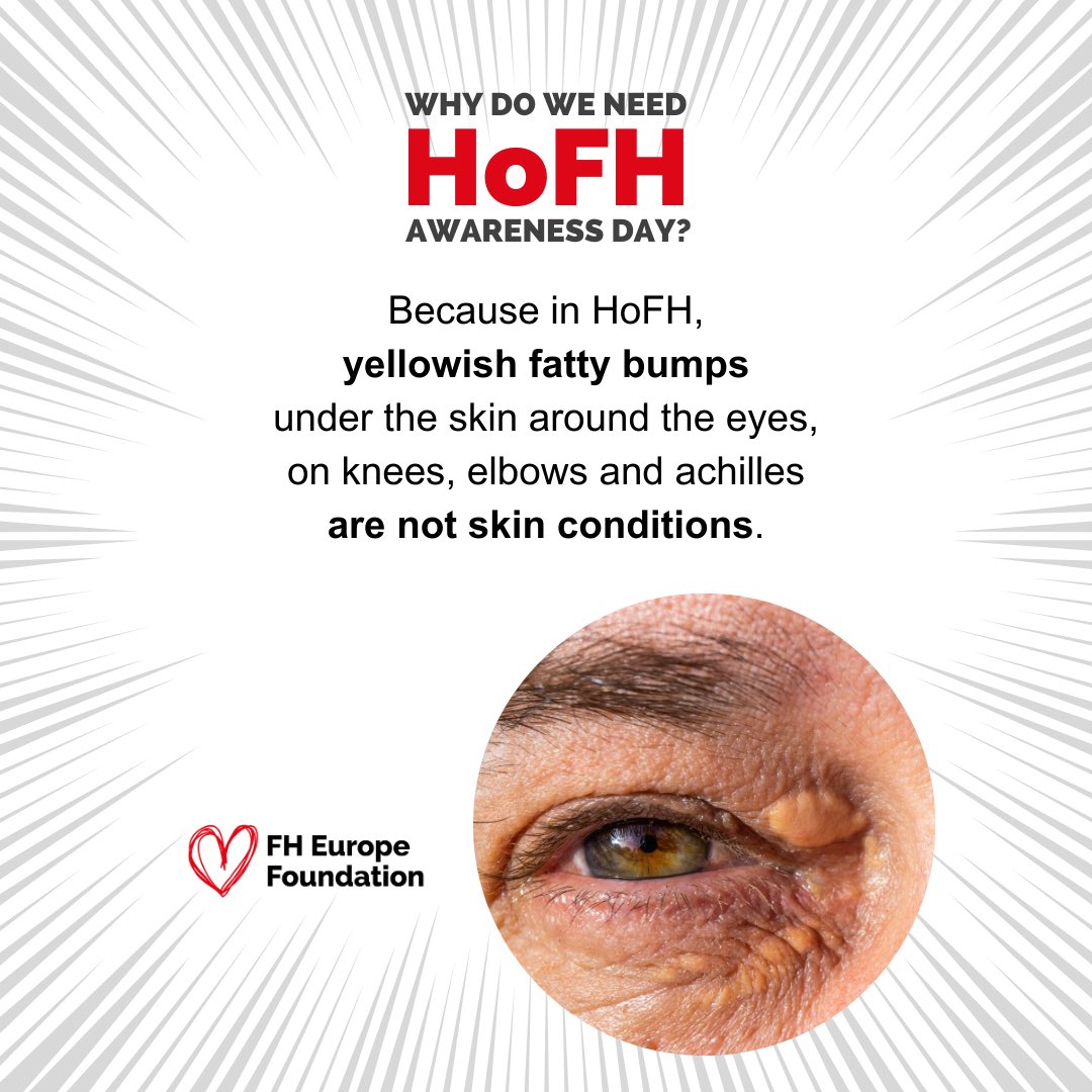 Don’t ignore yellowish fatty bumps under the skin around eyes, on knees, elbows, Achilles tendons, fingers or intimate areas. Irrespectively of age. Those might be #cholesterol deposits and signs of #HoFH. Raise awareness about severe & #rare FH. #KnowHoFH #FindHoFH #Unite4HoFH
