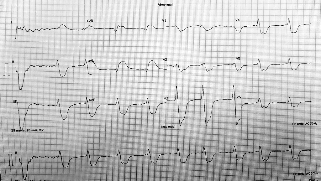 Ugly ROSC EKG. How long do you wait until you record an EKG? 

#cardiologist #Cardiology #CardioEd #CardioTwitter #cardiovascular #EKG #ECG #STEMI #OMI #MedTwitter #paramedics #CathLab