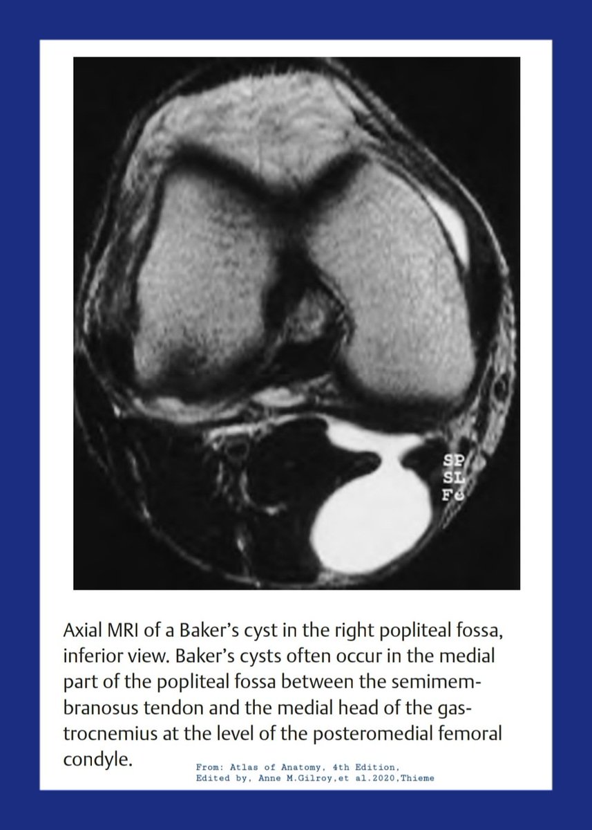 🔴Gastrocnemio-semimembranosus bursa (Baker’s cyst):

Painful swelling behind the knee may be caused by a cystic outpouching of the joint capsule (synovial popliteal cyst).

This frequently results from an increase 
in intra-articular pressure (e.g., in rheumatoid arthritis).