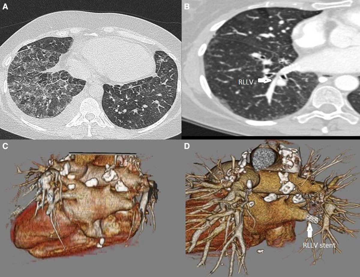 Images in Thorax: Unilateral pleural effusion with pulmonary hypertension in sarcoidosis #WorldPHDay @pulmvasculardoc thorax.bmj.com/content/early/…