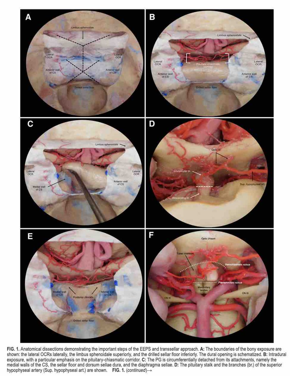 #OnlineFirst: Endoscopic endonasal pituitary sacrifice for select tumors with retrochiasmatic and/or retrosellar extension: surgical anatomy, operative technique, and case series. 

thejns.org/view/journals/….