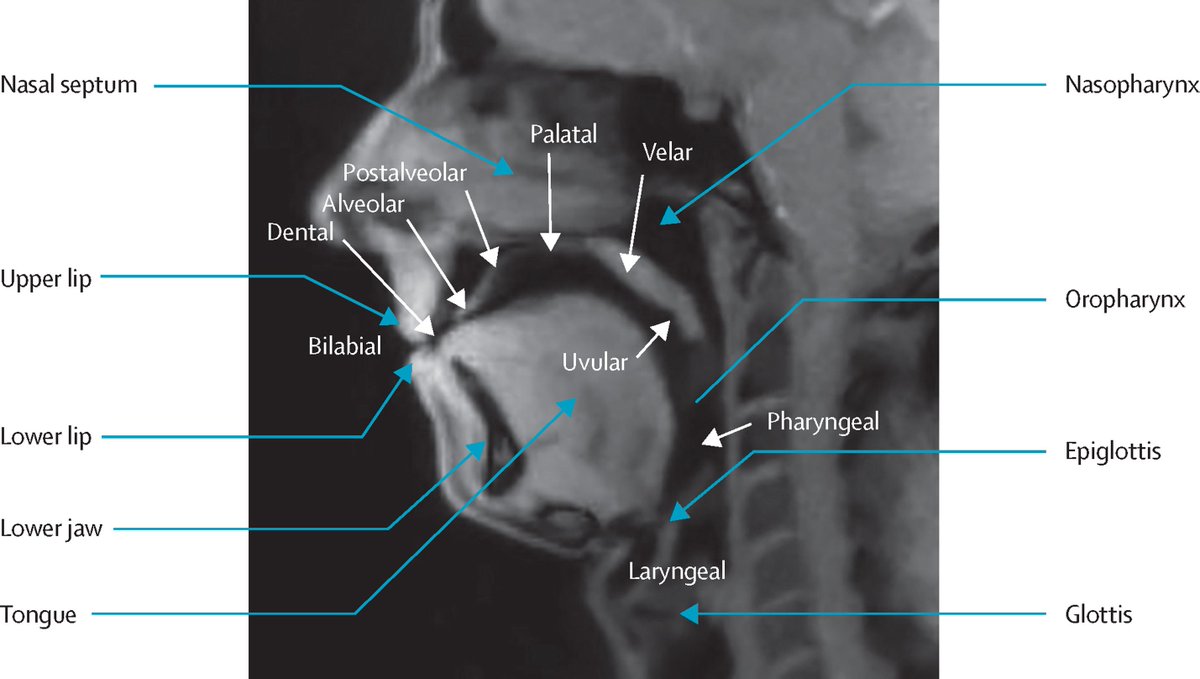 A 42-year-old man presented with a history of an intermittent disorder of speech fluency beginning around the age of 4 years.

He had no medical history and on clinical examination was found to be fit and well. 

Find out more in a new #TLClinicalPic: buff.ly/3Uoq6Oo