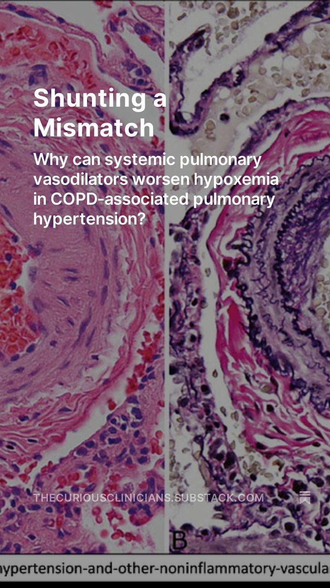 Looking to learn a little physiology and medicine this Sunday morning? Grab some ☕️ and read our latest episode's show notes about why pulmonary vasodilators can worsen hypoxemia w/ COPD-associated pulmonary hypertension. open.substack.com/pub/thecurious… curiousclinicians.com/2024/05/01/epi…