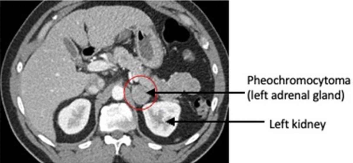 Pheochromocytoma - Adrenal catecholamine-secreting tumor; s/s: HA,  sweating,  palpitations, tremors, vision chgs; PE: HTN, orthostasis; Dx: ↑24h urinary catecholamines & metanephrines, or ↑plasma metanephrines, CT or MRI; Rx: alpha-blocker prior to beta-blockade --> resection