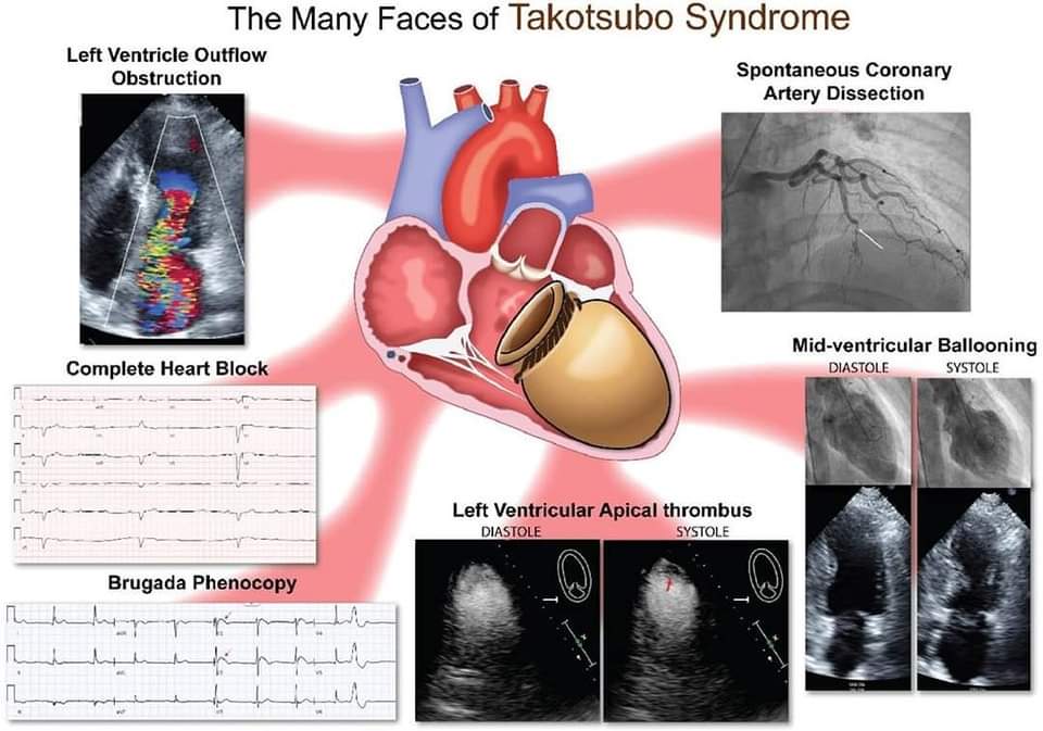 🔴The many faces of takotsubo syndrome: A #2024review #OpenAccess 

sciencedirect.com/science/articl…
#CardioEd #cardiology #Cardiotwitter