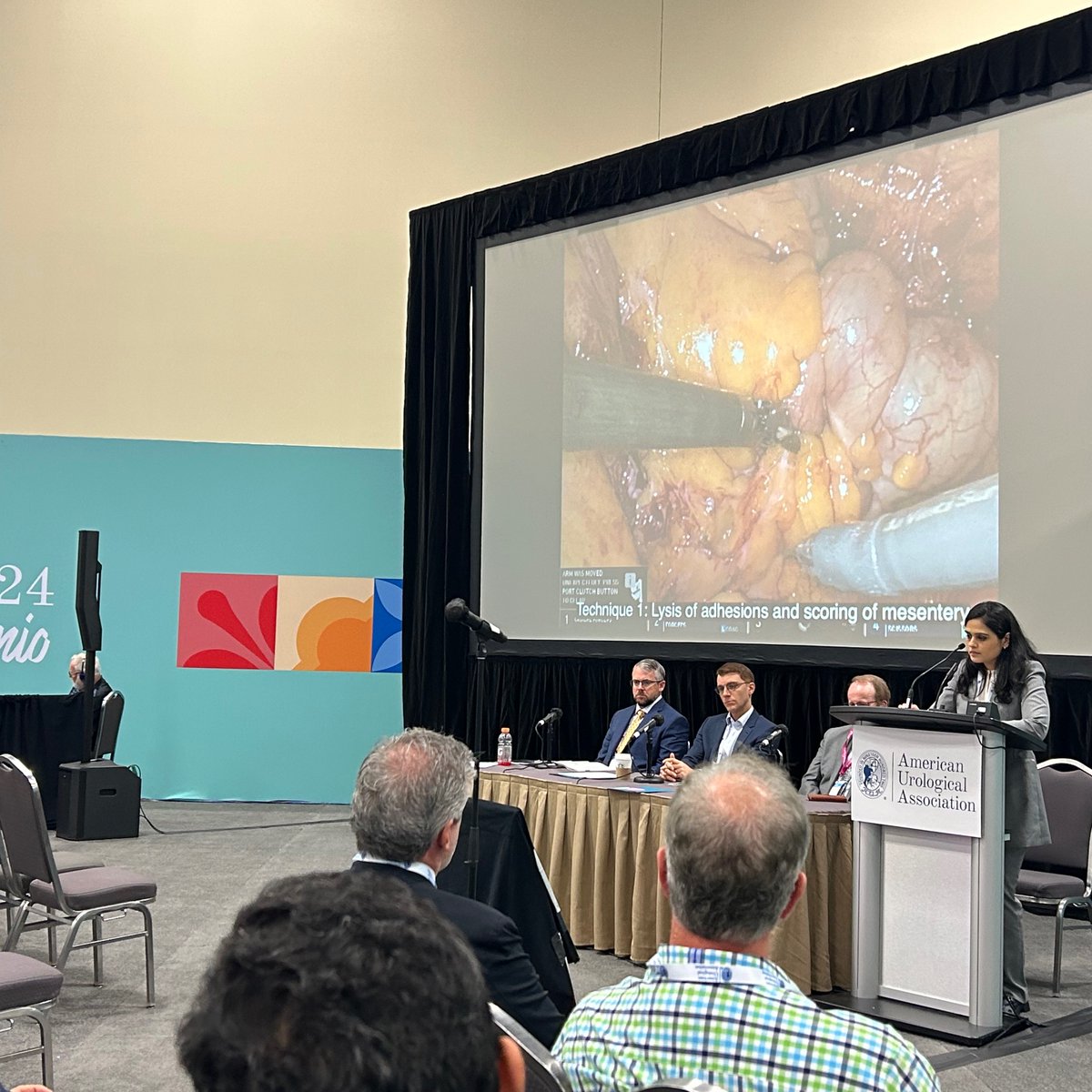 Had an excellent video abstract session at AUA 24 describing the difficult intracorporeal neobladder and techniques to bring the ileum down. A huge shout-out to my mentors Peter Wiklund @MehrazinMD @DrJohnSfakianos for innovating these brilliant strategies! #AUA24