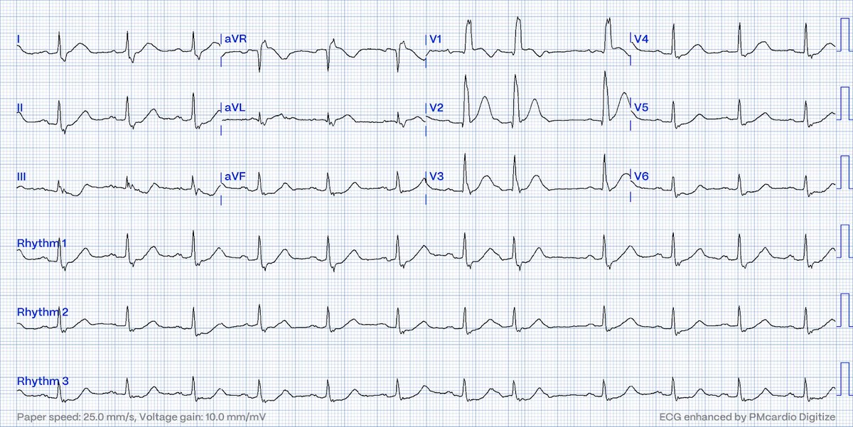 Do you need to be a trained health care professional to diagnose subtle OMI on the ECG? hqmeded-ecg.blogspot.com/2024/05/do-you…
